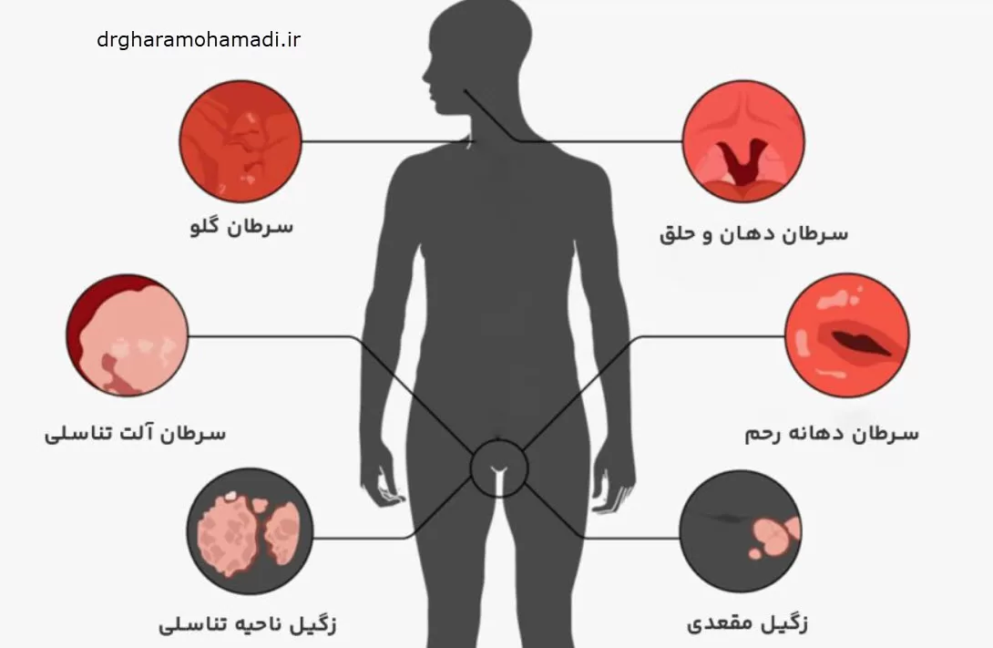 راه های انتقال ویروس hpv زگیل تناسلی