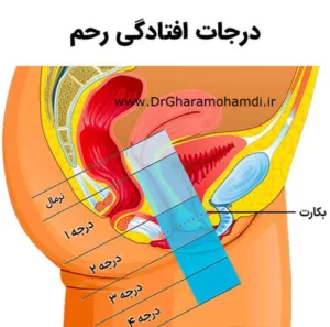 درجات افتادگی رحم و درمان افتادگی رحم - متخصص زنان در شهریار دکتر اکرم قرامحمدی