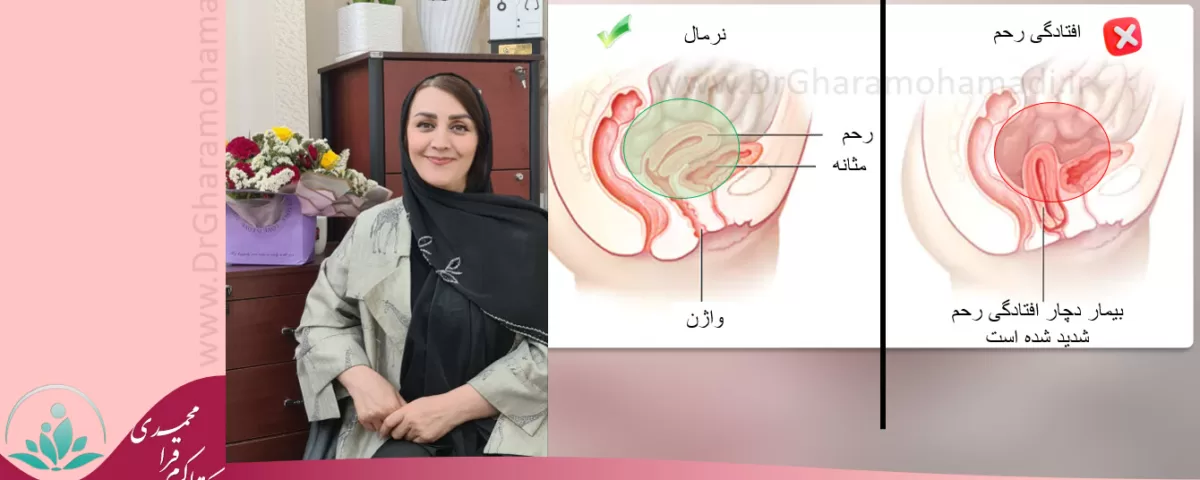 مشکلات افتادگی زنان - درمان افتادگی زنان - افتادگی رحم و مثانه در شهریار و اندیشه