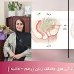 مشکلات افتادگی زنان - درمان افتادگی زنان - افتادگی رحم و مثانه در شهریار و اندیشه