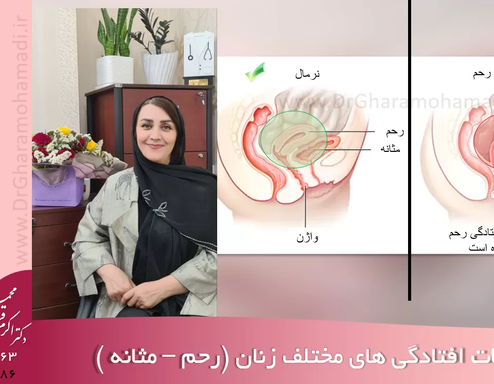 مشکلات افتادگی زنان - درمان افتادگی زنان - افتادگی رحم و مثانه در شهریار و اندیشه