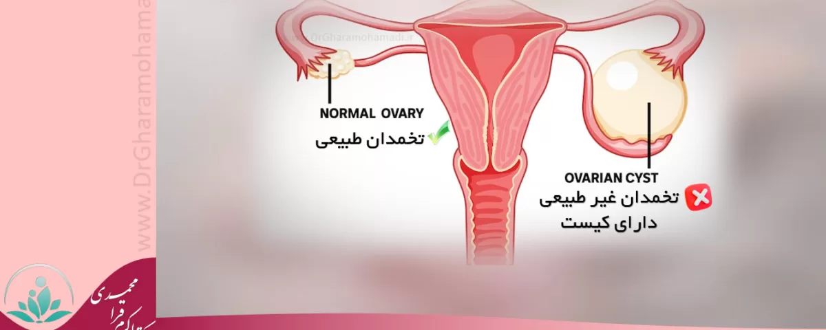 درمان کیست تخمدان - دکتر زنان شهریار