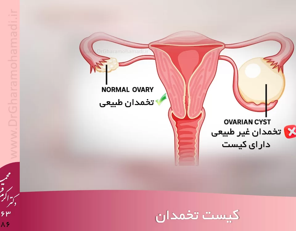 درمان کیست تخمدان - دکتر زنان شهریار