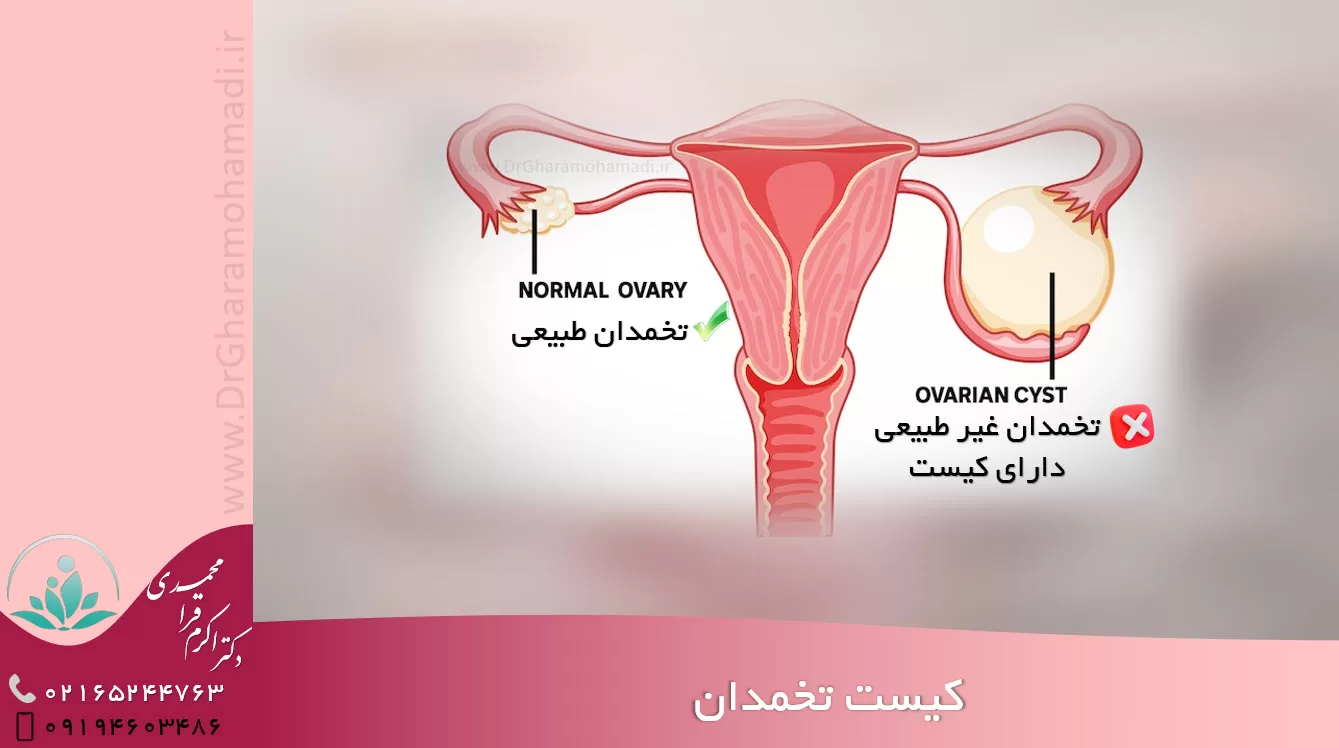 درمان کیست تخمدان - دکتر زنان شهریار