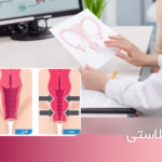 واژینوپلاستی تنگ کردن واژن در شهریار اندیشه غرب تهران