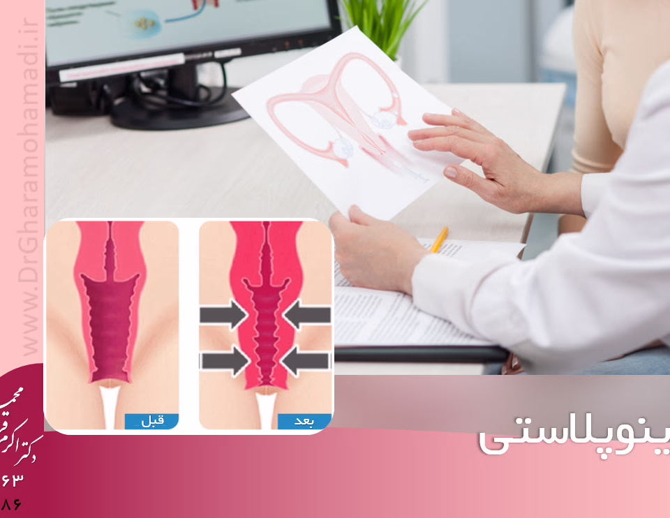 واژینوپلاستی تنگ کردن واژن در شهریار اندیشه غرب تهران