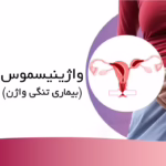 واژینیسموس بیماری تنگی واژن