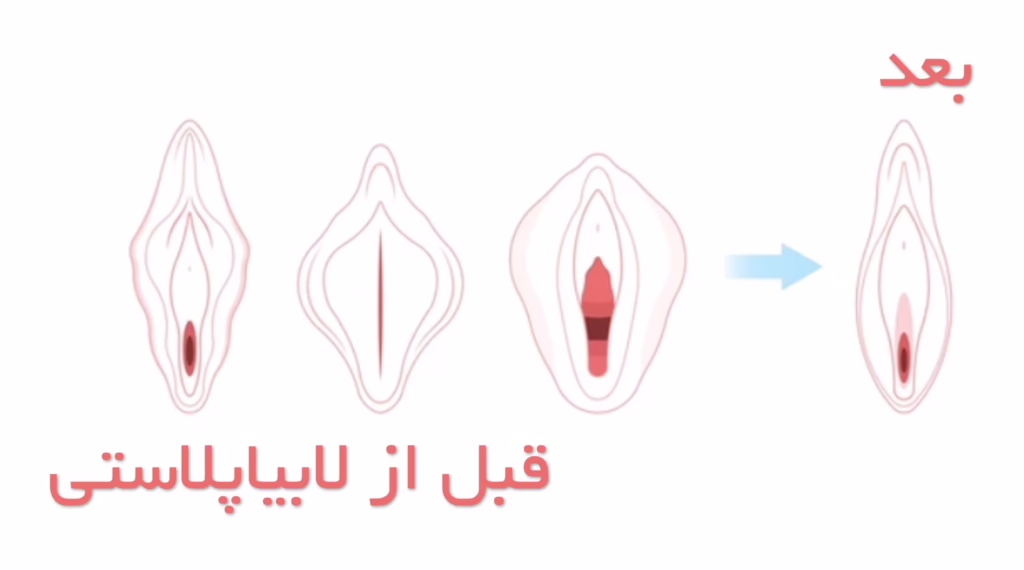 لابیاپلاستی قبل و بعد عکس