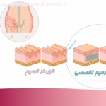 ترمیم تزریق ژل واژن و رفع عدم تقارن ژنیتال- بازگشت به فرم ایده آل با تکنیک لایه ای 2 ترمیم تزریق ژل واژن و رفع عدم تقارن ژنیتال- بازگشت به فرم ایده آل با تکنیک لایه ای