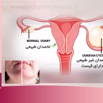 سندرم تخمدان پلی کیستیک PCOS + دلایل، علائم، تشخیص و درمان تخصصی 3 کیست تخمدان پلی کیستیک PCOS